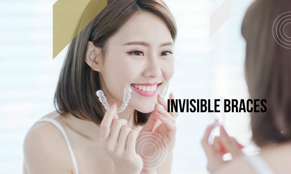 Invisible braces
